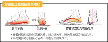 爱矫健护足课堂:扁平足要注意科学选鞋